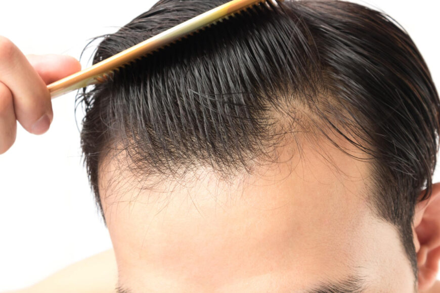 Echte Haartransplantation vs. Künstliche Haartransplantation