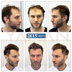 The Norwood 2 – Understanding This Early Stage of Hair Loss