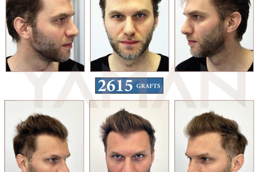 The Norwood 2 – Understanding This Early Stage of Hair Loss