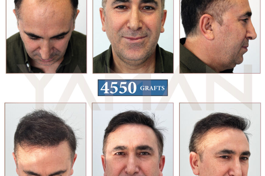 4550 Grafts Before and After Hair Transplant