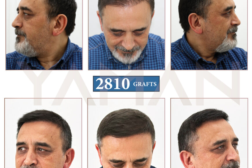 Hair Transplant Pics before After-2860 Grafts