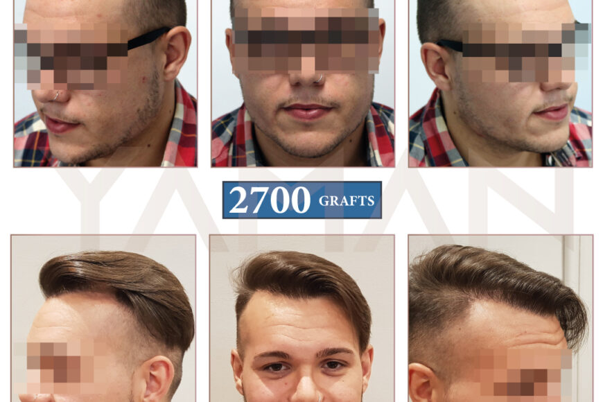 2700 Hair Graft Before and After – 14 Months Result