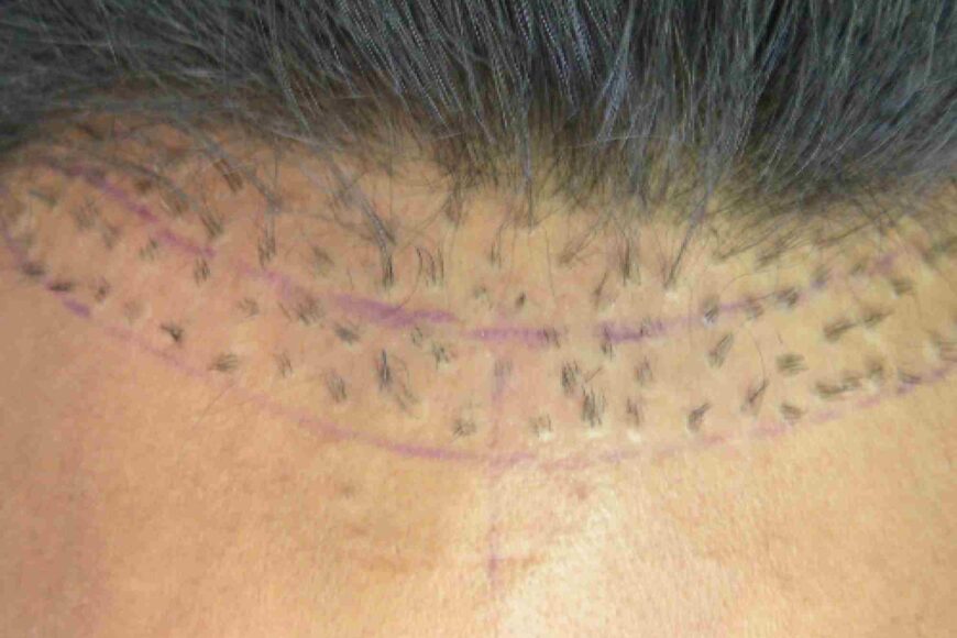 Haarimplantate vs. Haartransplantation: Was ist besser?