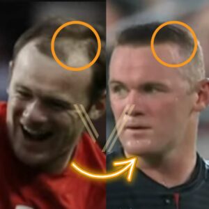 Wayne Rooney Hair Transplant