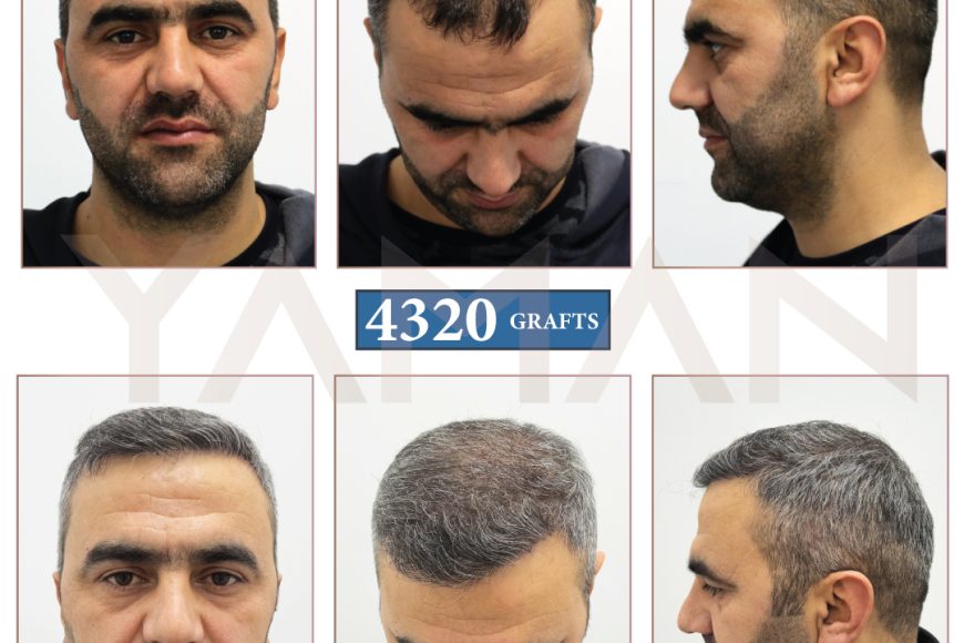 4320 Grafts Hair Implants Before and After Pics-7 Years Result