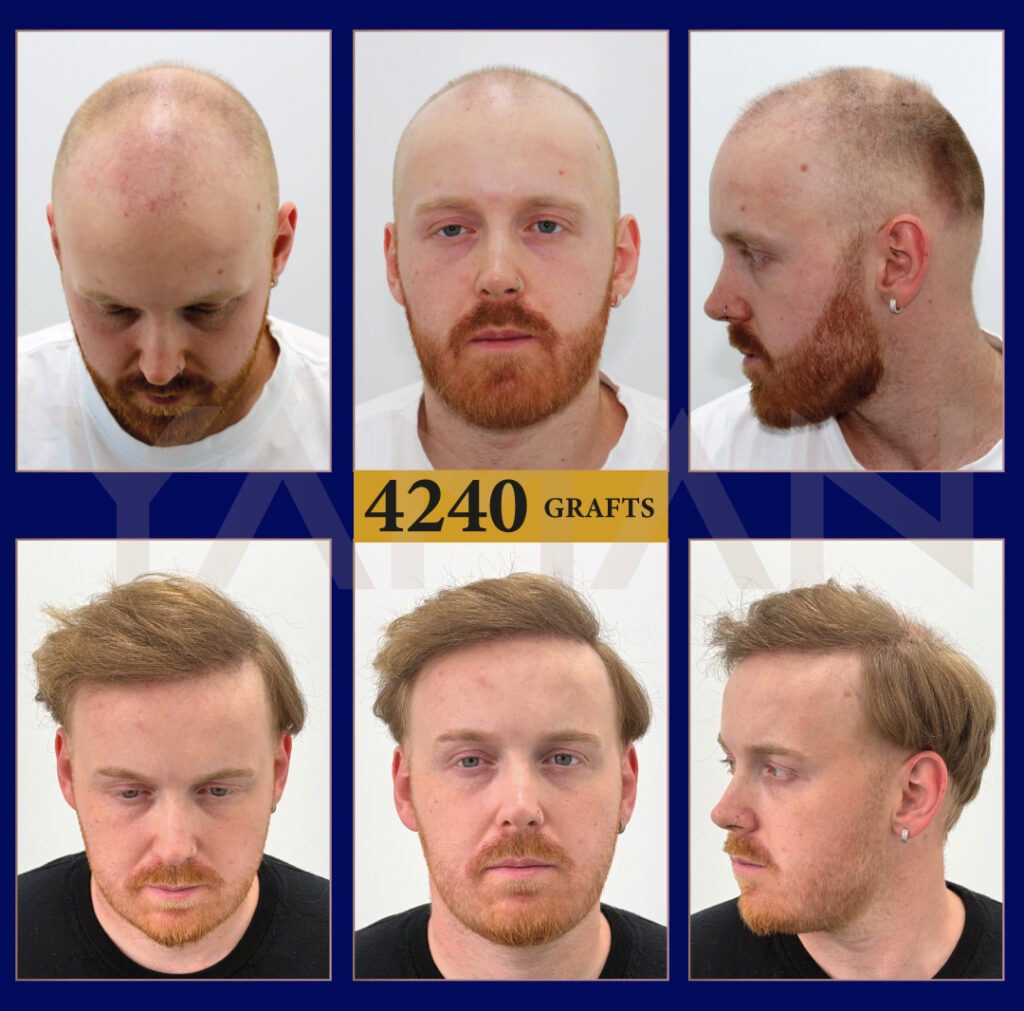 4240 Grafts Hair Transplant Result