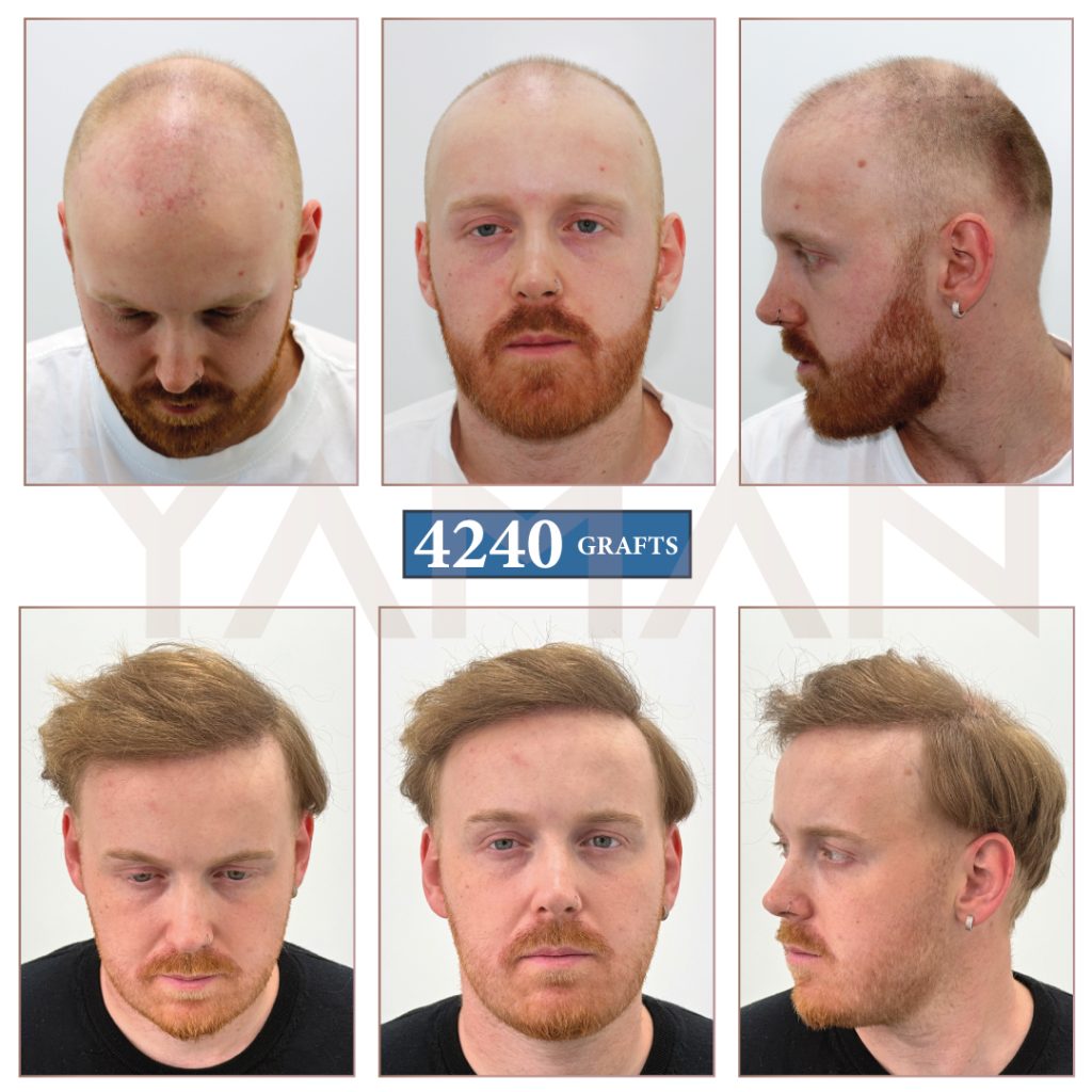 4240 Grafts Hair Transplant