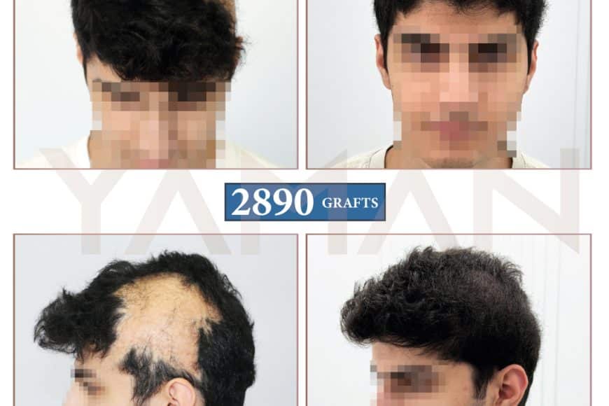 Hair Transplant for Burns Scar Alopecia : 2890 Grafts Before After