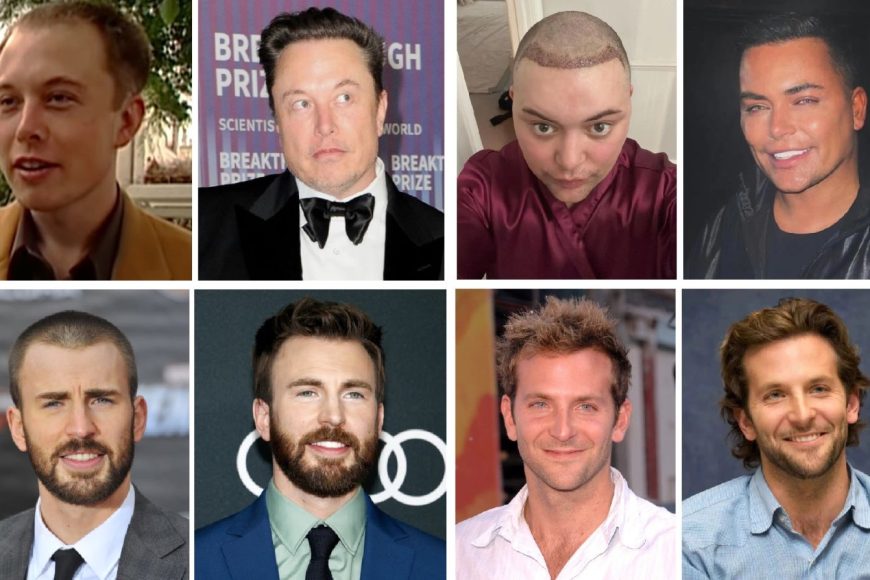 Why Celebrity Hair Transplants Look So Natural?