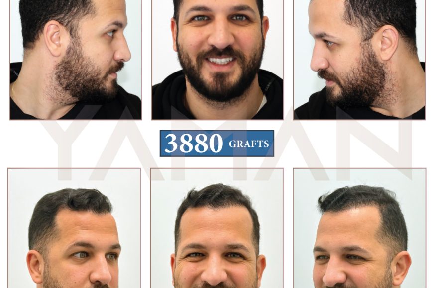 3880 Grafts Before and After Case: A Successful Hair Transplant Story