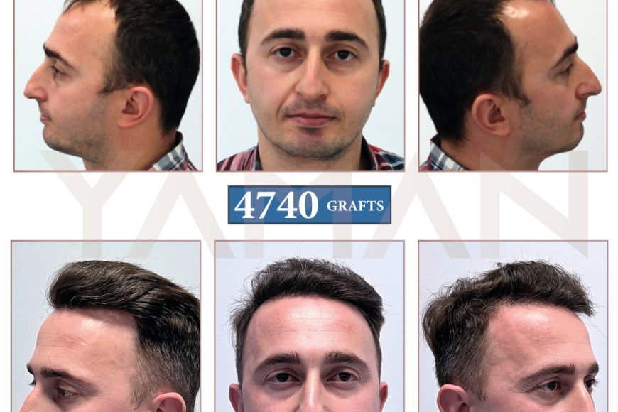 How Does 4740 Grafts Before and After Result Look So Natural?