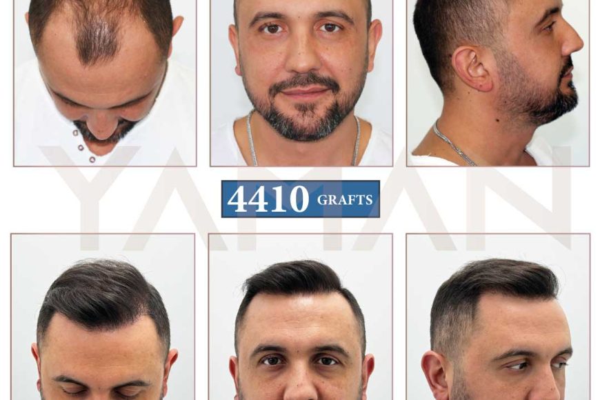 4410 Grafts Haartransplantation Vorher Nachher – 16 Monate Ergebnis