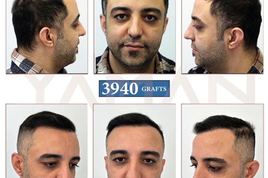 3940 Grafts DHI-Haartransplantation vor und nach der Operation – Ergebnis nach 7 Monaten