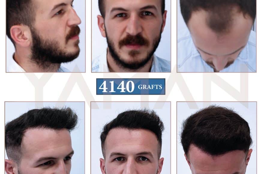 4140 Grafts Haarimplantate Vorher Nachher – 11 Monate Ergebnis