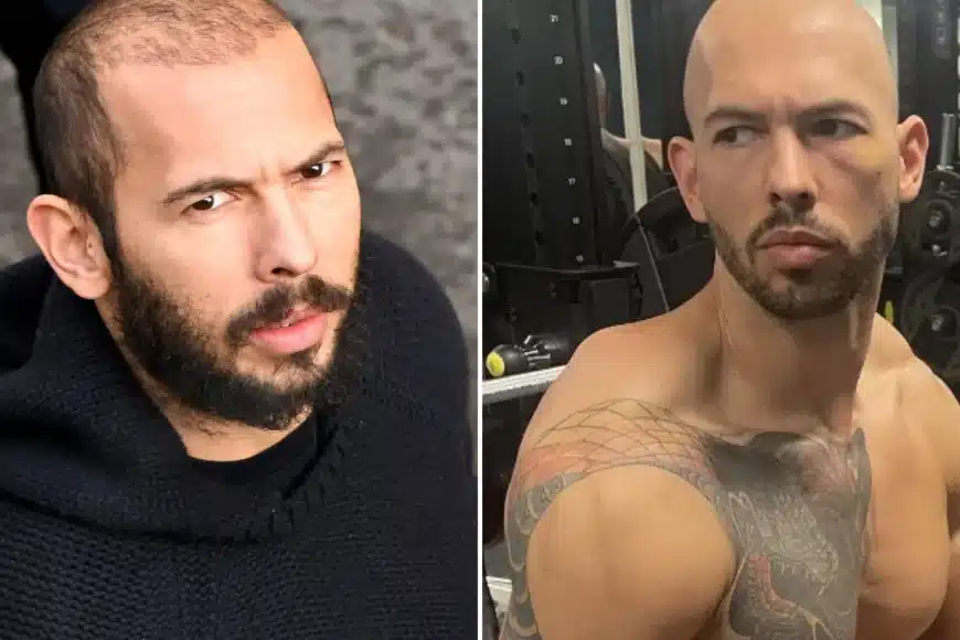 Transplante capilar de Andrew Tate: é mesmo um novo começo?