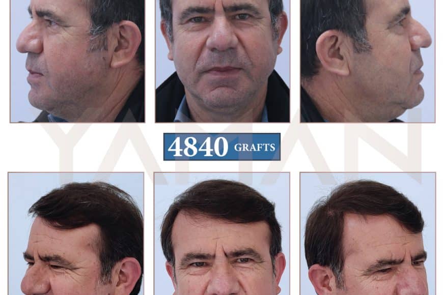 Trapianto di capelli 4840 innesti prima e dopo – Risultato a 16 mesi di un paziente di 60 anni