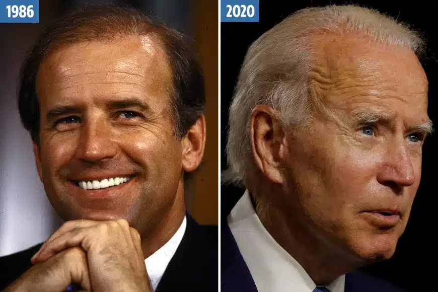 Trapianto di capelli di Joe Biden: chirurgia estetica per celebrità politiche