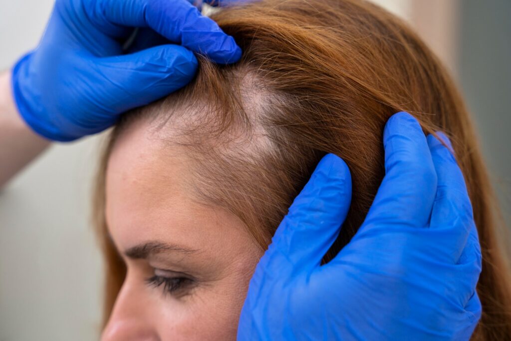 Which Hair Loss Treatment Provides Permanent Results