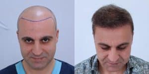 What to Expect in Hair Transplant Before and After Photos?