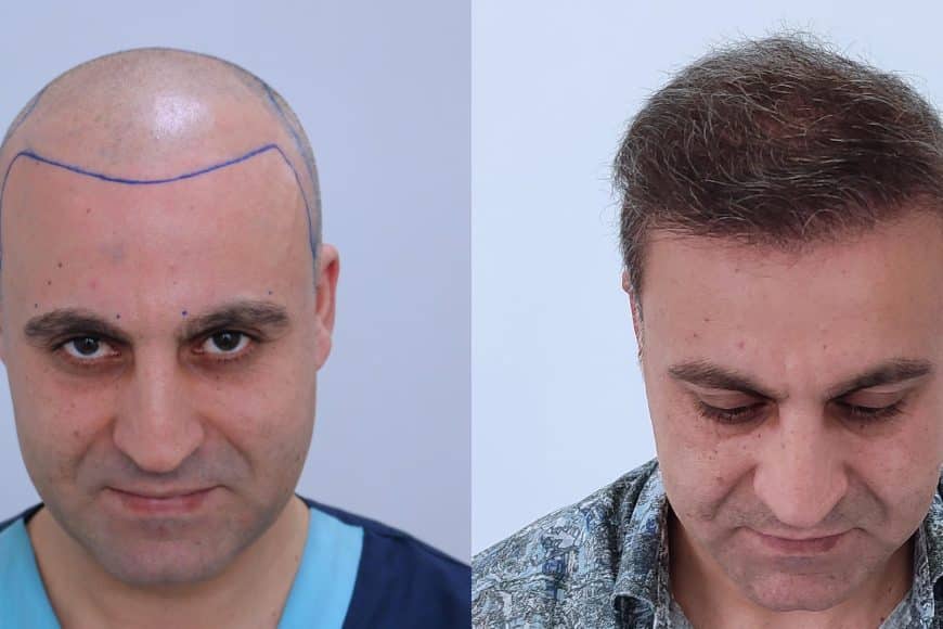 Trapianto di capelli 4060 Grafts Prima sessione: risultati 3 anni prima e dopo