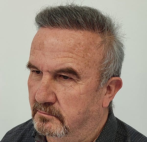 Istanbul Hair Replacement: 3540 Grafts Before and After