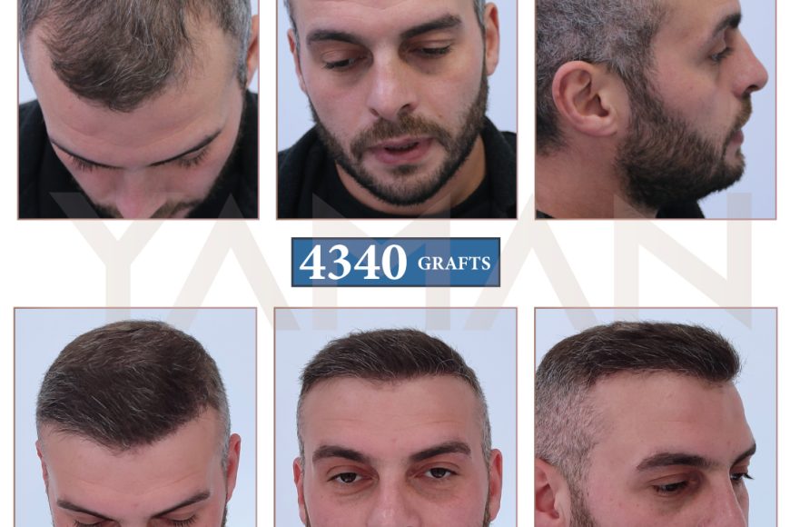 4340 innesti di capelli in Turchia – Foto del trapianto di capelli prima e dopo
