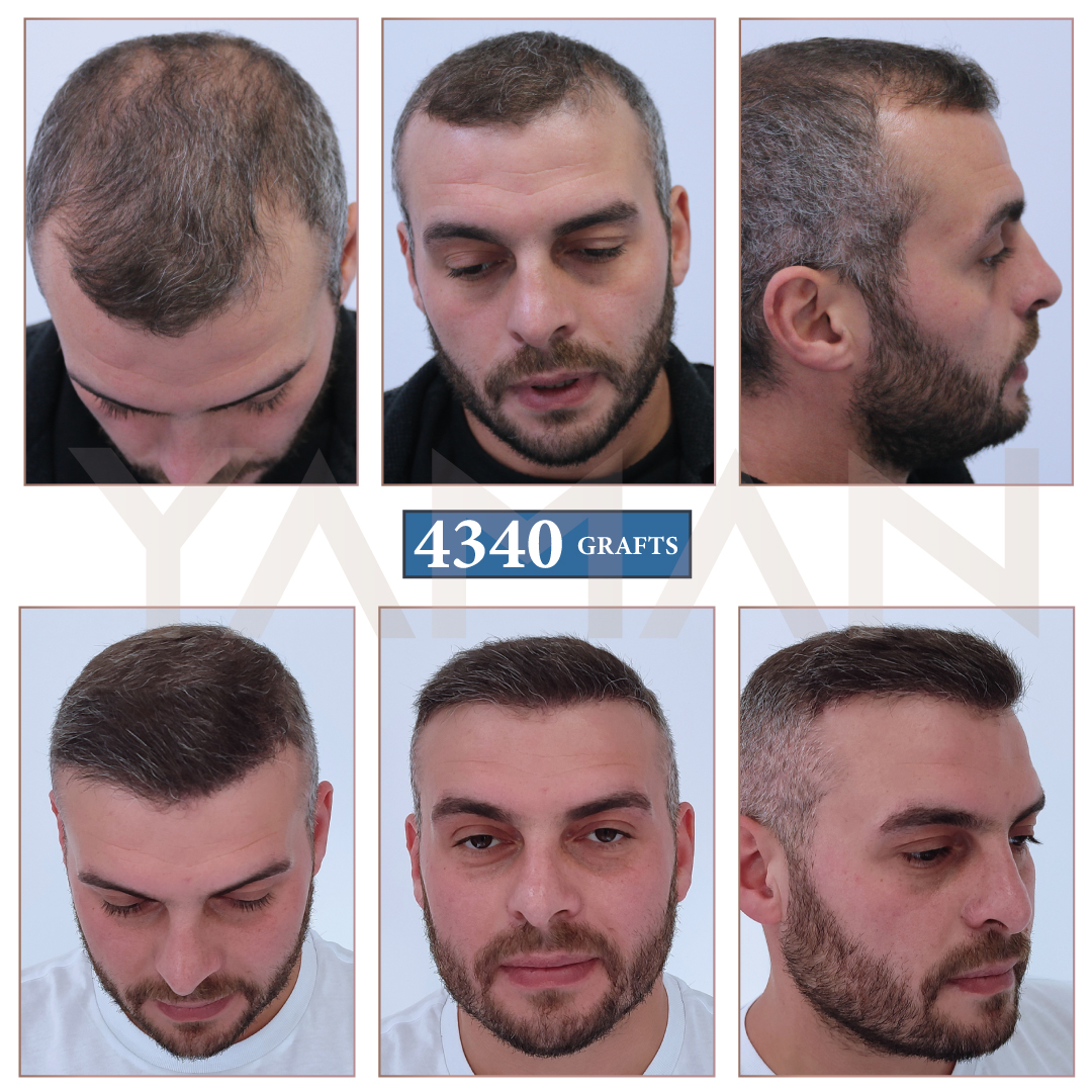 Lot De 4 Sérums Evocapil Anti-chute Cheveux 3% - Après Greffe, Soin Fortifiant