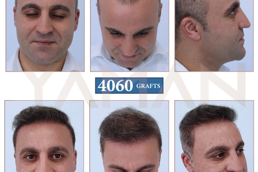 4060 Grafts Hair Transplant First Session: 3 Years Before and After Results