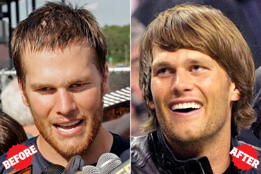 Trapianto di capelli di Tom Brady