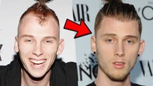 MGK Hair Surgery: Machine Gun Kelly Hair Loss Treatments