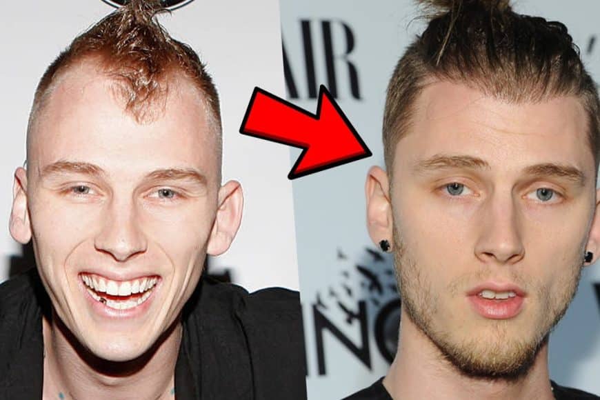 Chirurgia dei capelli MGK: trattamenti contro la caduta dei capelli Machine Gun Kelly