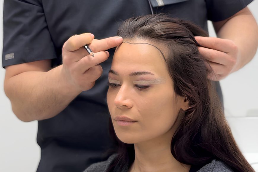 Female Hair Transplant: Techniques, Candidacy, Results and Long-Term Outcomes