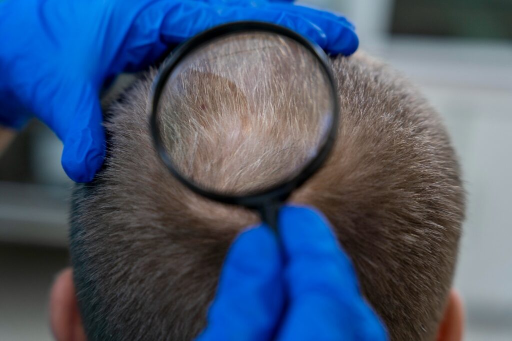 Preventing Balding