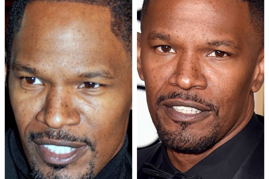 Jamie Foxx Hairline Surgery Timeline: 20 Years of Hair Transformation