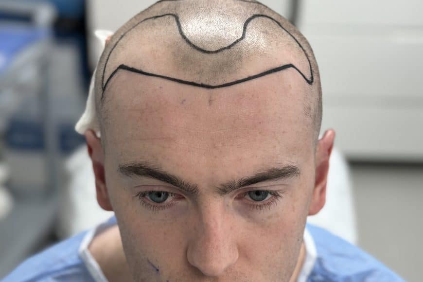 Temple Hair Transplant in Turkey