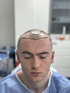 Temple Hair Transplant in Turkey