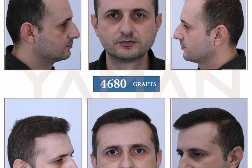 4680 Grafts Hair Transplant Before and After Pictures – 3 Year Result