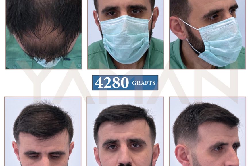 4280 Hair Grafts: 1 Year Result Male Implant Surgery Video