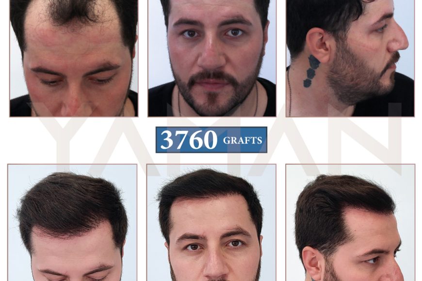 3760 Grafts Before and After Hair Restoration Turkey