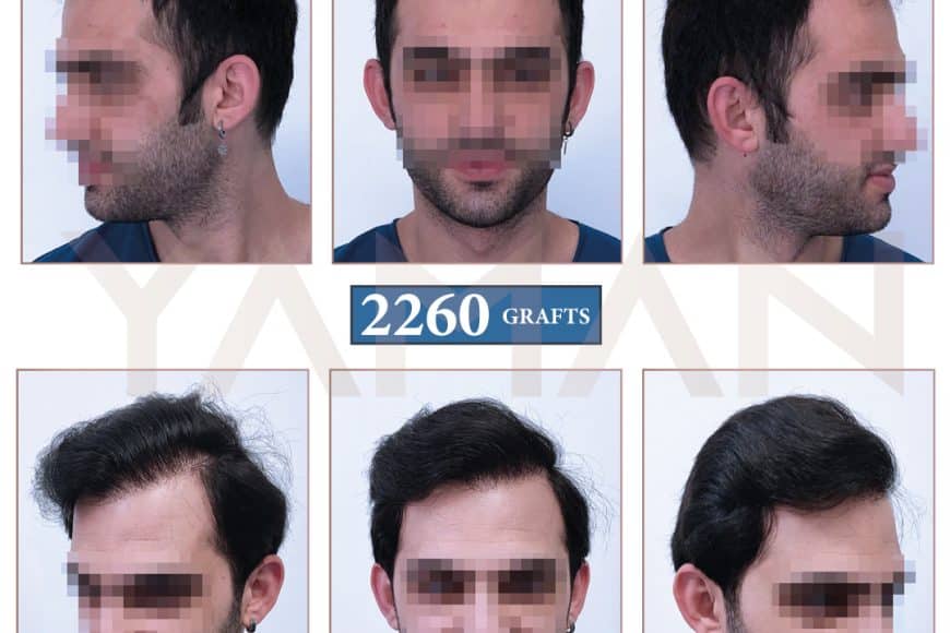 2260 Grafts Hair Transplant Before and After Results – Real Transformation at Our Turkey Clinic
