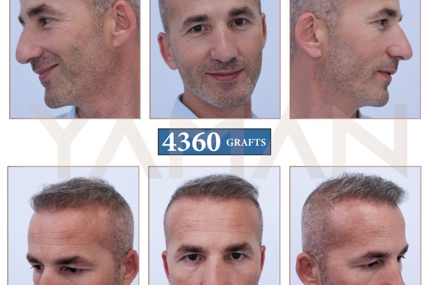 2 Years Result – 4360 Grafts Hair Transplant Turkey Before and After Case