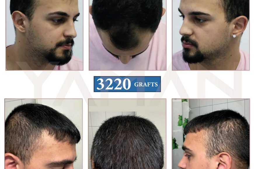 2 Years Result – 3220 Grafts Hair Transplant Before and After Case