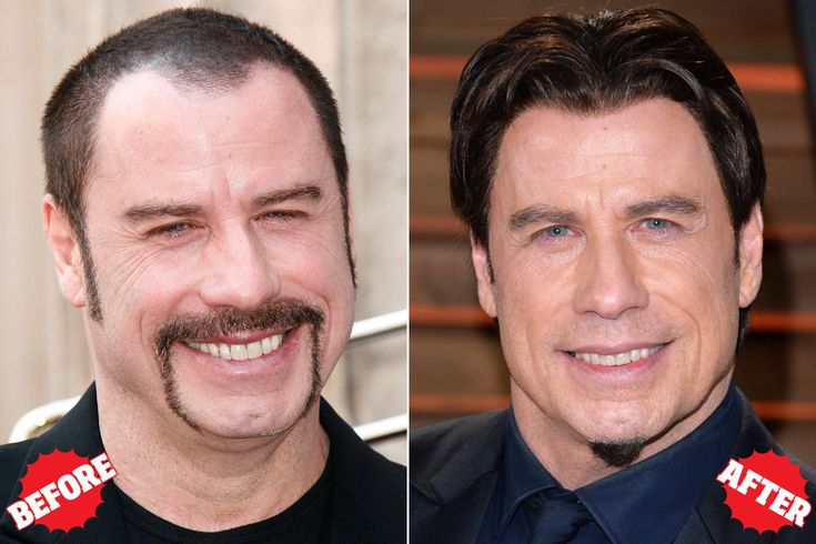 John Travolta Hair Transplant: Is He Using a Hair System or Real Implants?