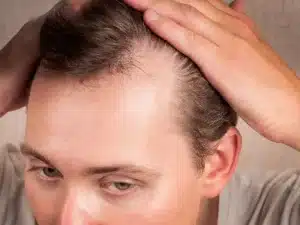M-Shaped Hairline: Most Common Questions