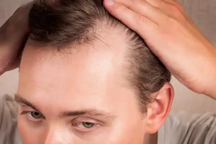 M-Shaped Hairline: Most Common Questions