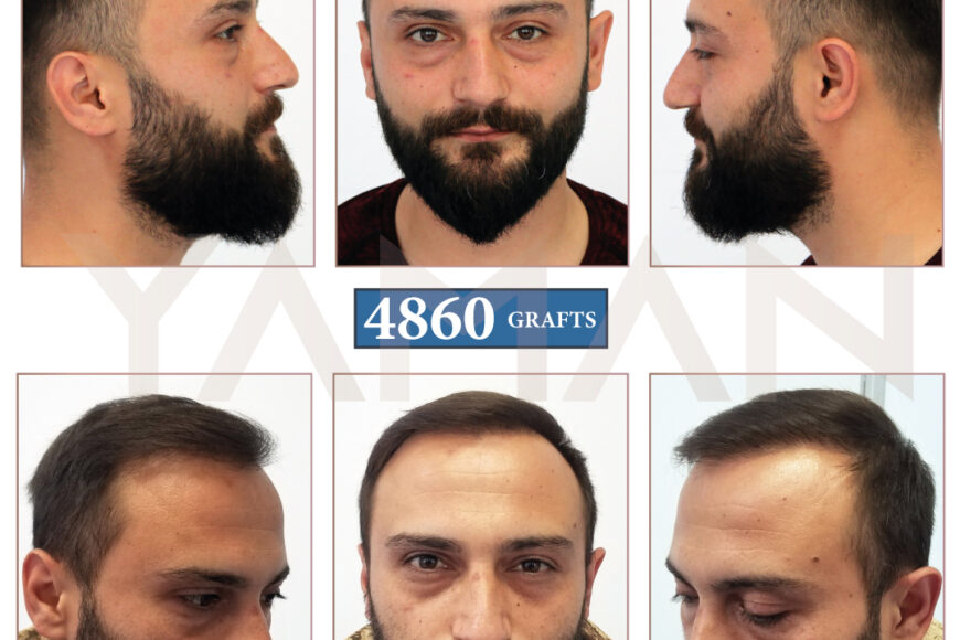 4860 Graft DHI Hair Transplant Results – 2-Year Before and After Case