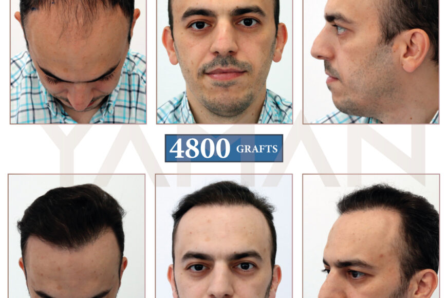 4800 Graft Before and After Hair Transplant: Impressive 10-Month Result