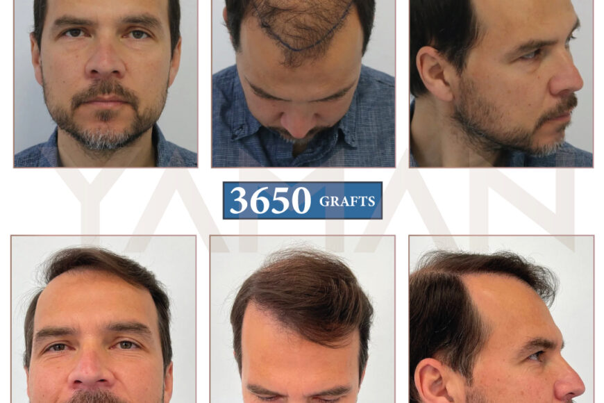 3650 Grafts Before and After Hair Transplant – 2 Year Result