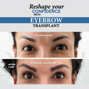 Do Eyebrows Grow Long after an Eyebrow Transplant?