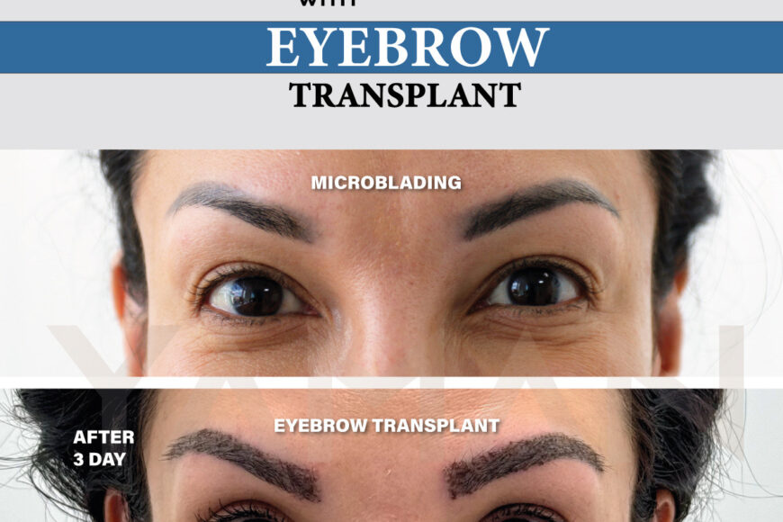Do Eyebrows Grow Long after an Eyebrow Transplant?